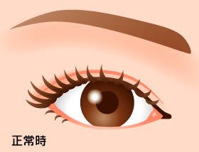 正常な眼瞼