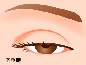 下垂時の眼瞼