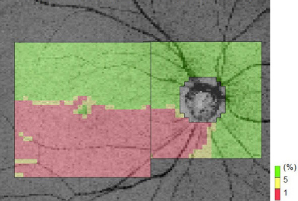 緑内障の網膜視神経線維層